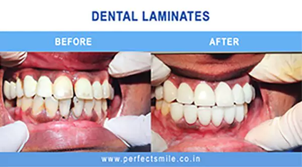 Smile makeover — before and after at Perfect Smile