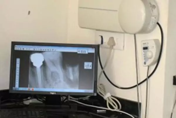 Orthodontic treatment — before and after at Perfect Smile