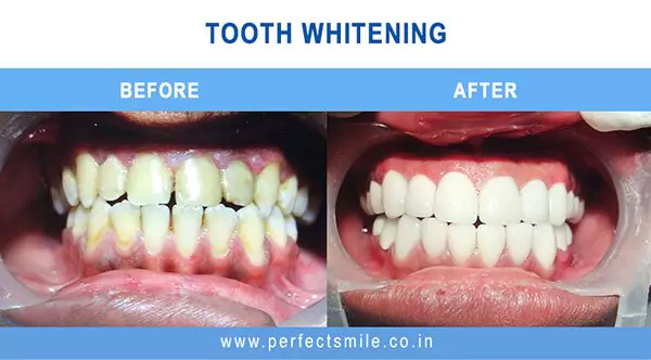 Dental veneers — before and after at Perfect Smile