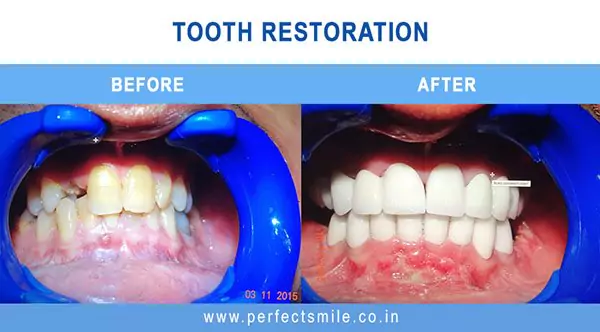 Teeth whitening — before and after at Perfect Smile